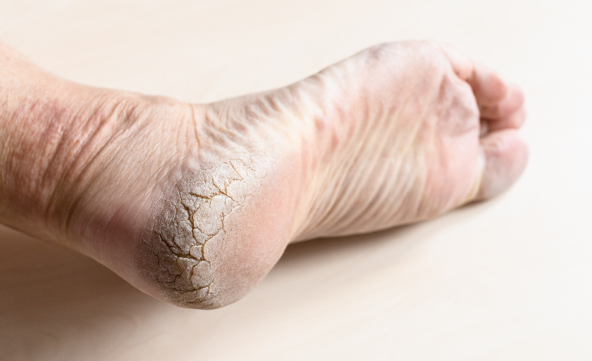 Cuidados com os pés para diabéticos: Prevenindo complicações