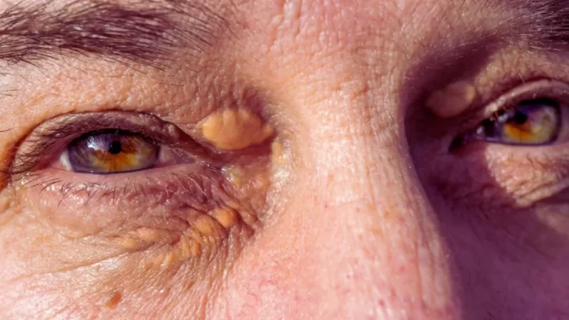 Diabetes e Saúde Ocular: Prevenção e Motivos que Podem Levar à Cegueira